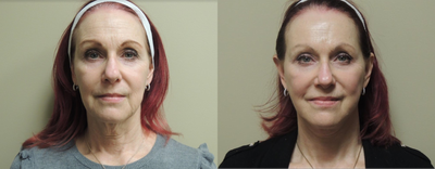 Facelift before and after photo