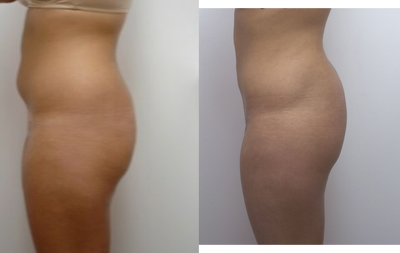 Liposuction before and after photo