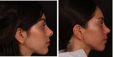 Rhinoplasty before and after photo
