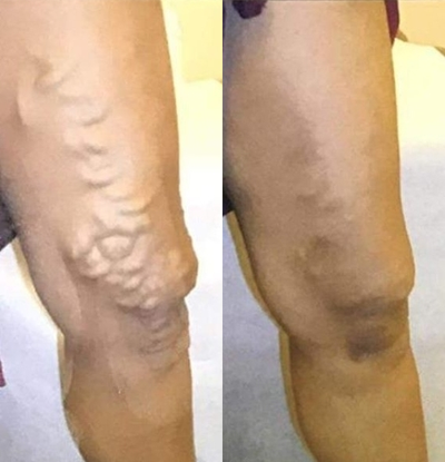 Sclerotherapy before and after photo