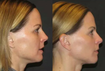 ThermiTight before and after photo