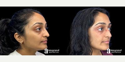 Eyelid Surgery before and after photo