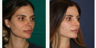 Rhinoplasty before and after photo