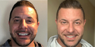 Botox before and after photo