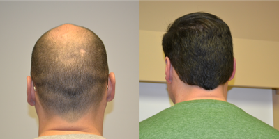 FUE Hair Transplant before and after photo