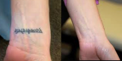Tattoo Removal before and after photo