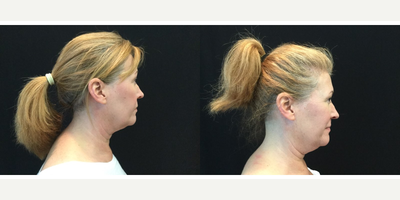 CoolSculpting before and after photo