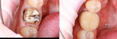 Dental Crown before and after photo