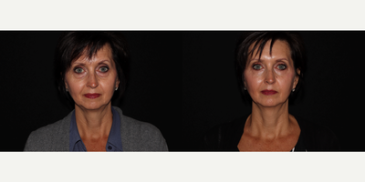 Dermal Fillers before and after photo
