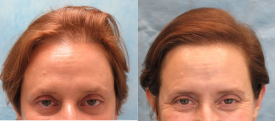 FUE Hair Transplant before and after photo