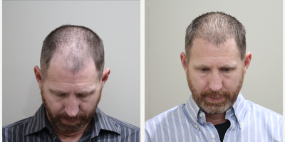 Hair Loss Treatment before and after photo