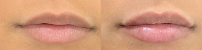 Lip Fillers before and after photo