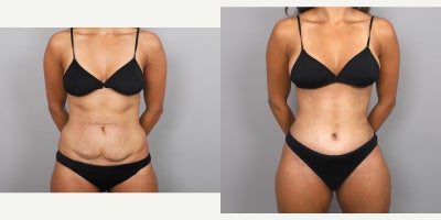 Mommy Makeover before and after photo