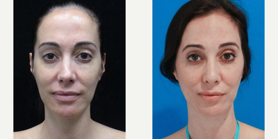 Rhinoplasty before and after photo