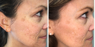 Halo Laser before and after photo