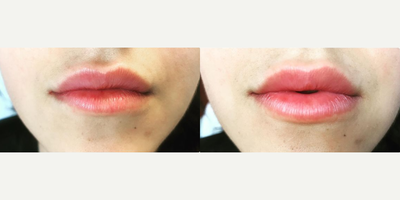 Juvederm before and after photo