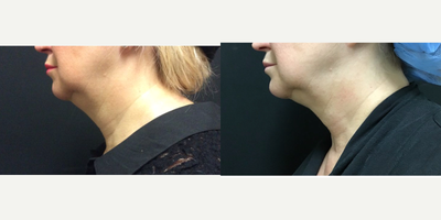 Kybella before and after photo
