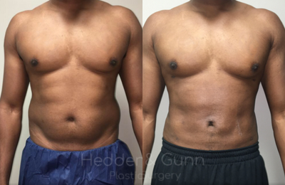 Liposuction before and after photo