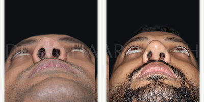 Revision Rhinoplasty before and after photo