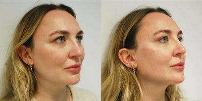 Dermal Fillers before and after photo