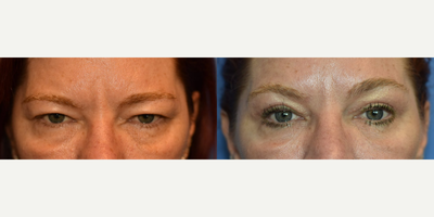 Eyelid Surgery before and after photo