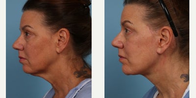Facelift before and after photo