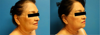 FaceTite before and after photo