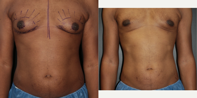 Gynecomastia Surgery before and after photo