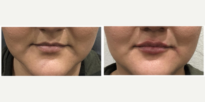 Juvederm before and after photo