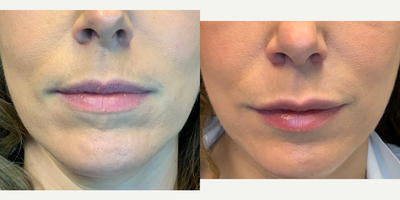 Lip Fillers before and after photo