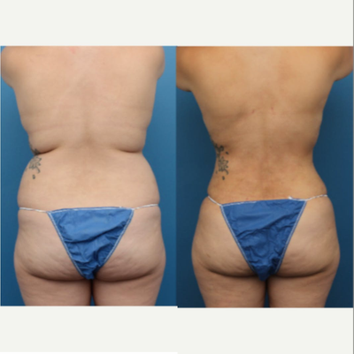 Liposuction before and after photo