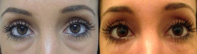 Restylane before and after photo