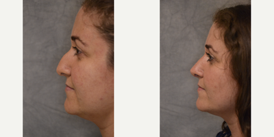 Rhinoplasty before and after photo