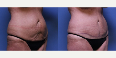 Tummy Tuck before and after photo
