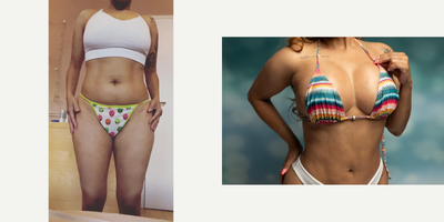 Breast Lift with Implants before and after photo