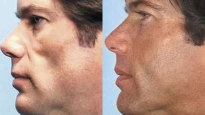 Facial Fat Transfer before and after photo