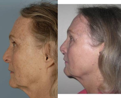 Fractional Laser before and after photo