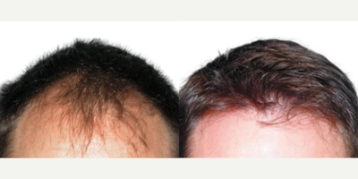 Hair Loss Treatment before and after photo