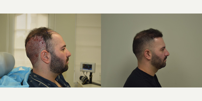 Hair Loss Treatment before and after photo