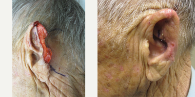 Mohs Surgery before and after photo