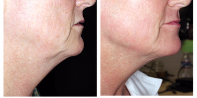 PrecisionTx before and after photo