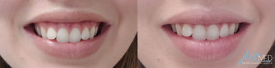 Botox for Gummy Smile before and after photo