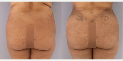 Brazilian Butt Lift before and after photo