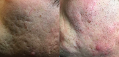 Dermal Fillers before and after photo