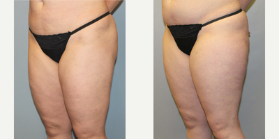 Liposuction before and after photo