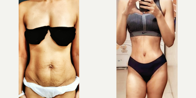 Liposuction before and after photo
