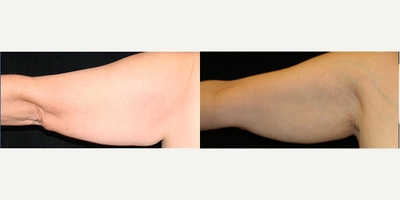 Arm Lift before and after photo