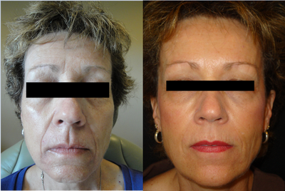 Juvederm before and after photo