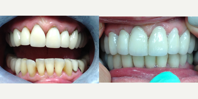 Smile Makeover before and after photo