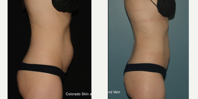 CoolSculpting before and after photo